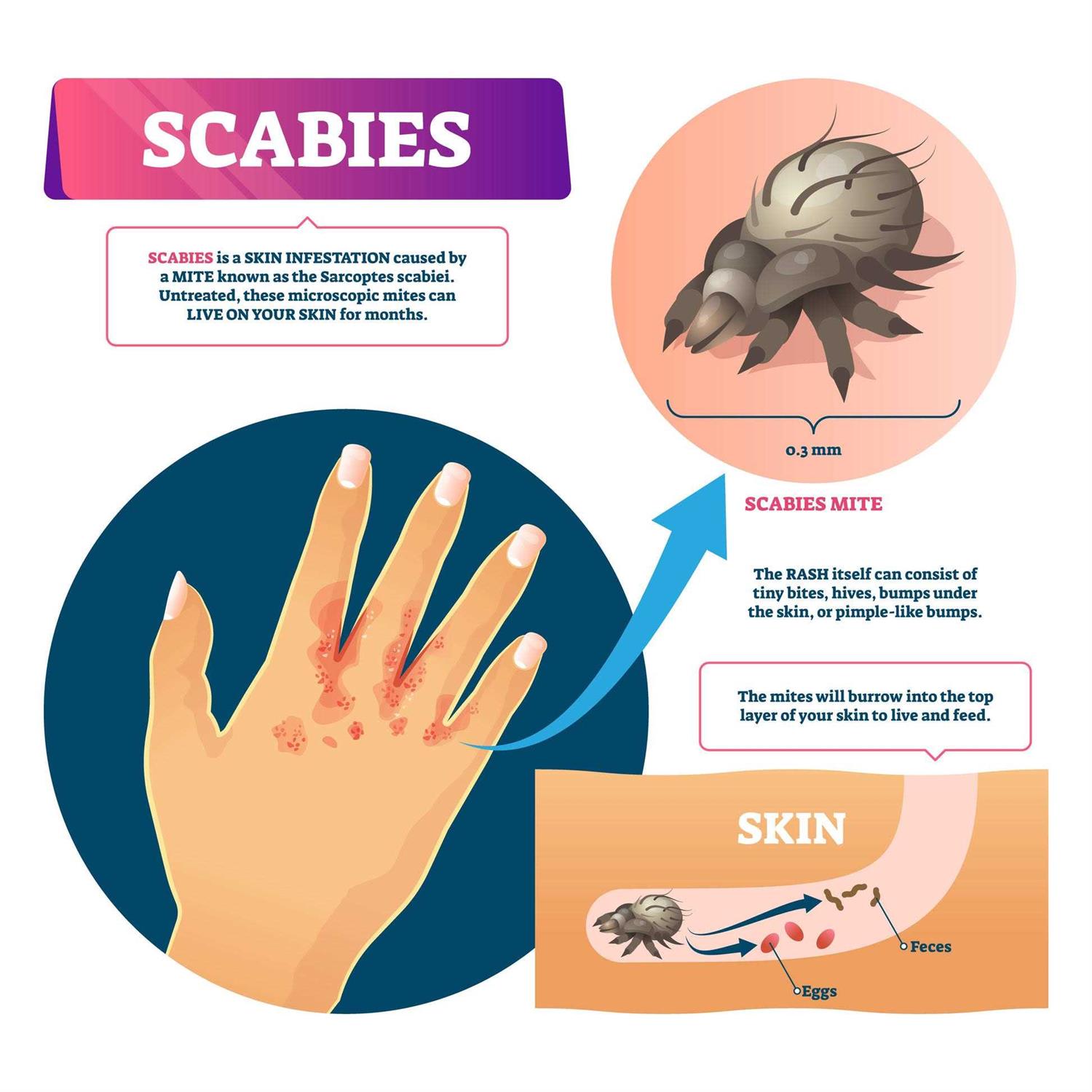 Naturasil Scabies Cream - Healthber